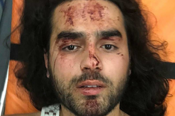 Robert is one of the people beaten in Shurnukh village in Syunik province